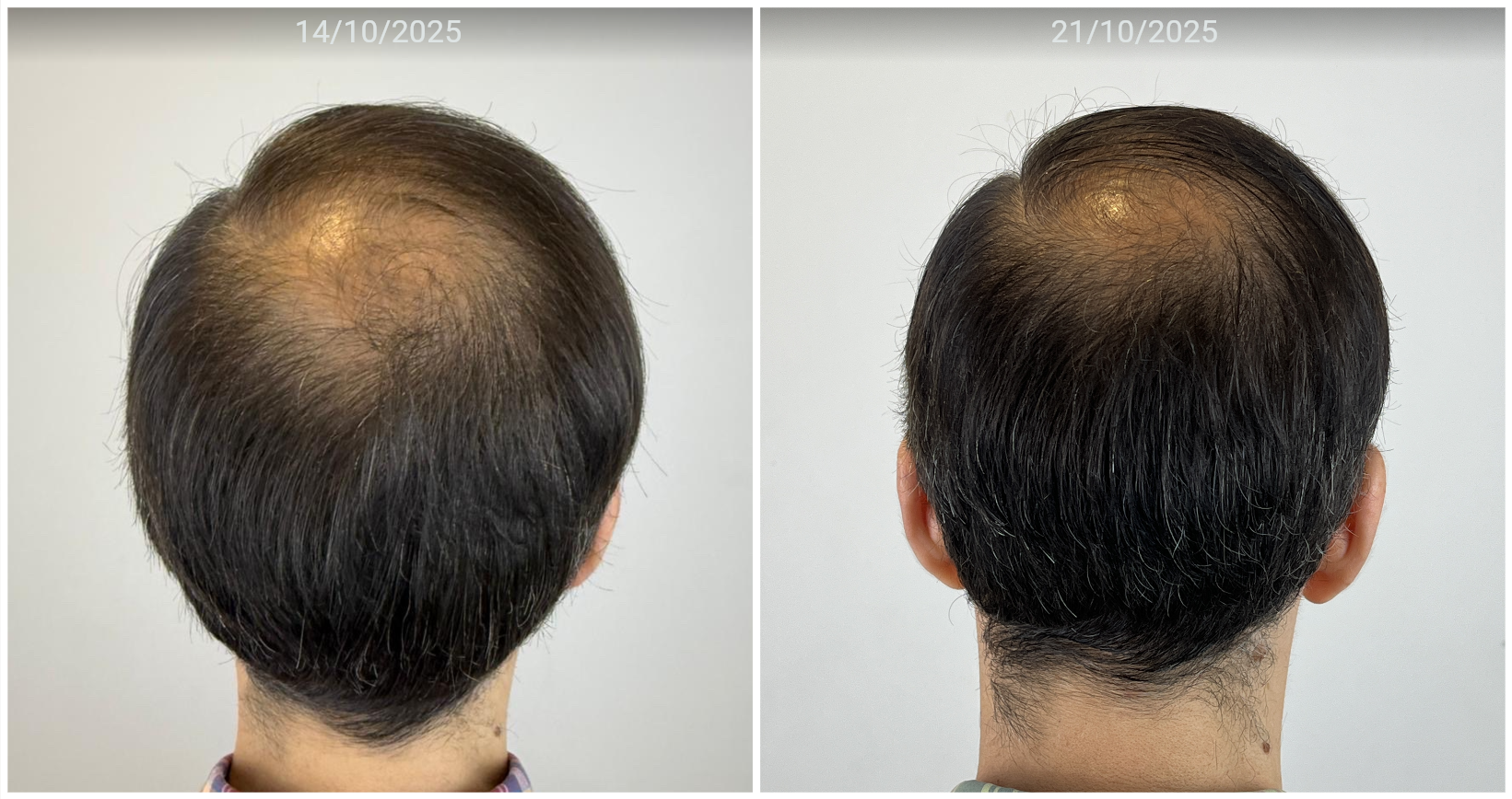 Antes e depois — coroa