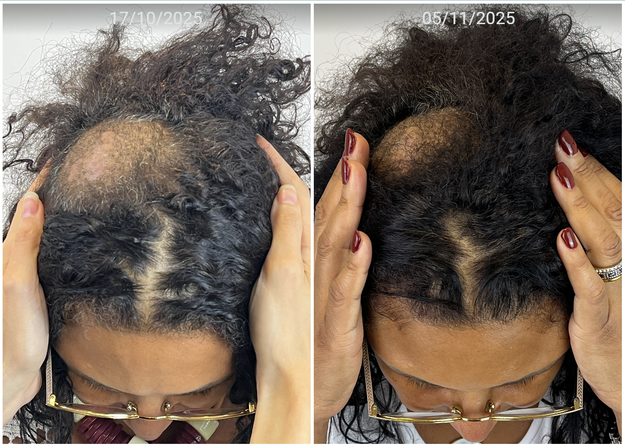 Antes e depois — topo